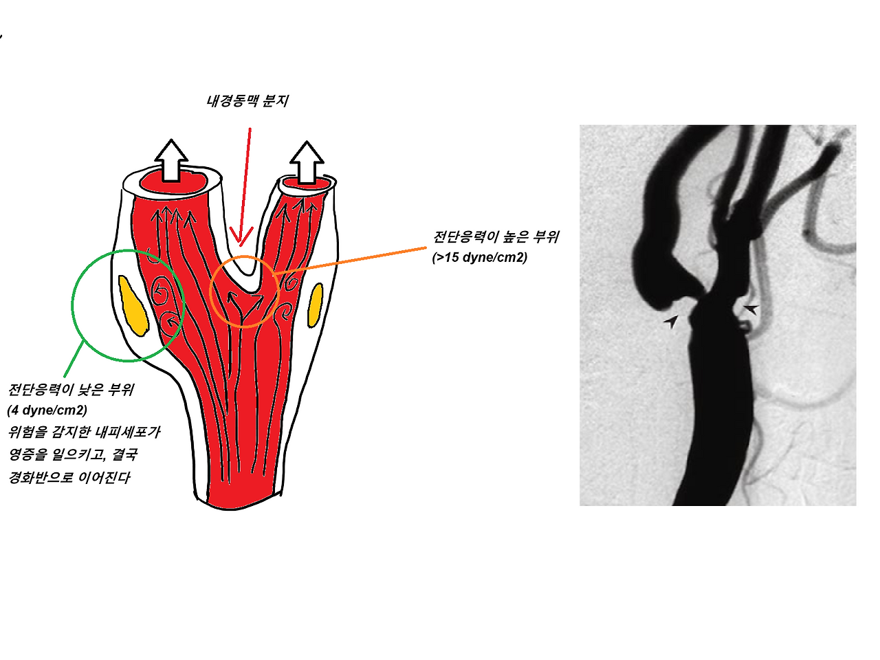 carotid_atheroma.png