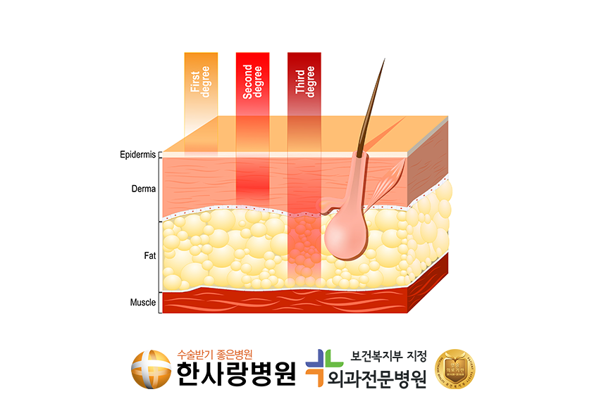 2도 화상, 3도 화상 차이 알고 계시나요?