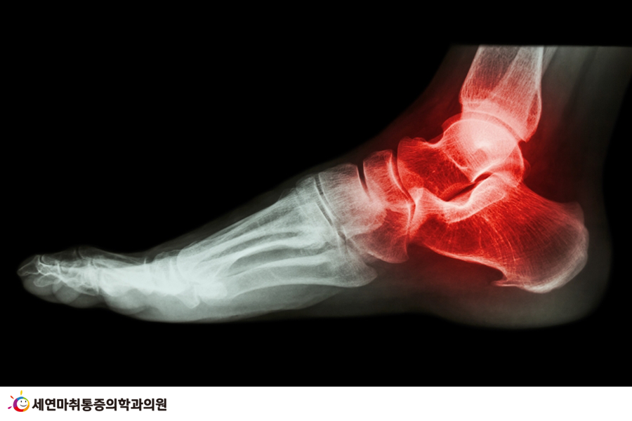아차 하는 순간 발목 삐끗, 초기 대처의 중요성