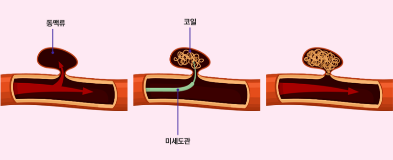 04화 비장 동맥류 투병일지(4)