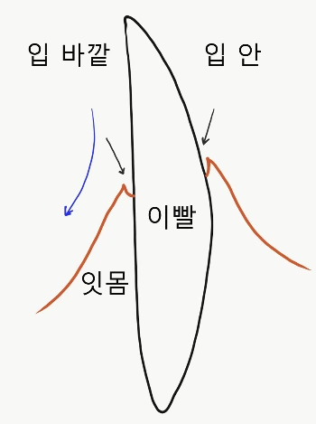 치주질환.PNG