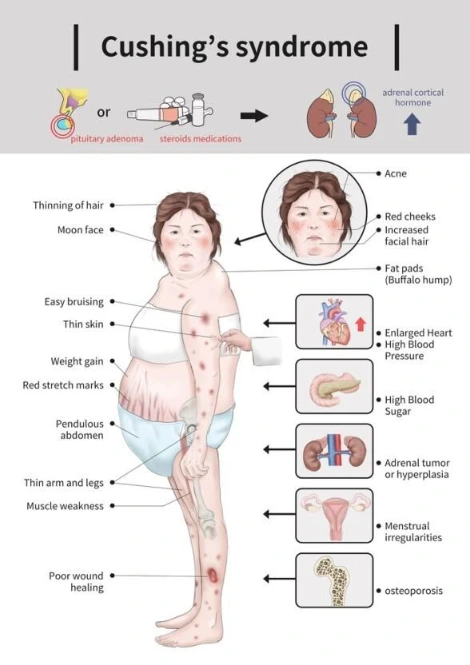 쿠싱증후군.jfif