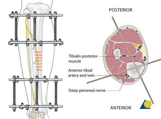 42EHS-RingFixIlisarov_4d_540.gif?type=w2