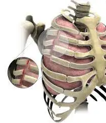 Multiple rib fracture.jfif