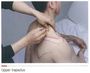 neck-trapezius1.PNG