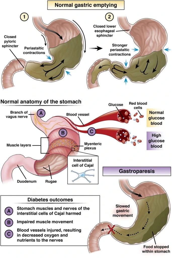CGH-PatientEd-Diabetic-gastroparesis-2020-min-684x1024.png?type=w1