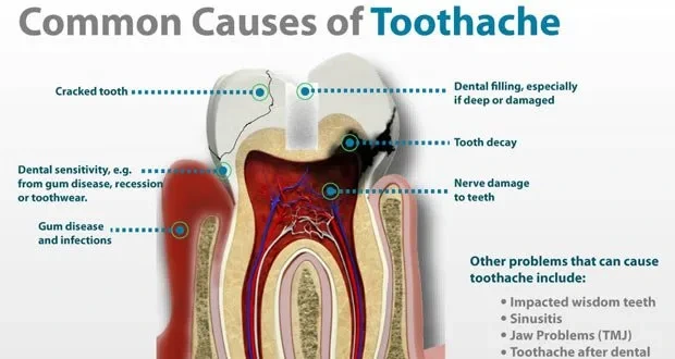 Toothache-causes-3.png?type=w1