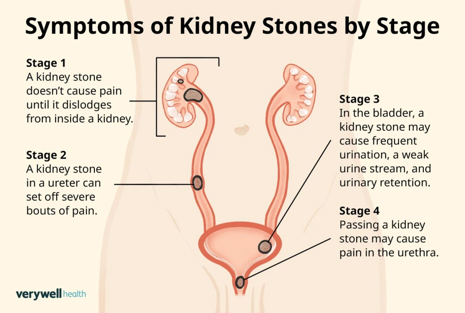 VWHNewCreate-SymptomsofKidneyStones-5df49f37c3794163a2356e2c6545e816.png?type=w1