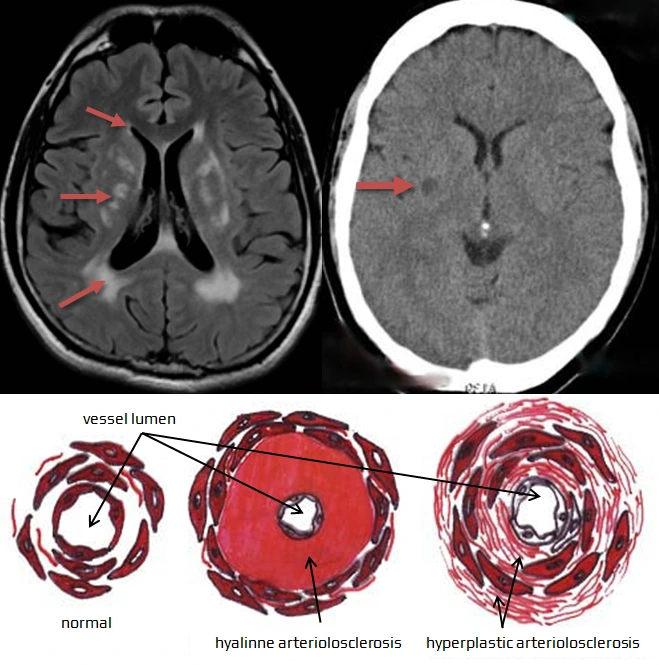 Subkortical-Ischemic-Vascular-Dementia.png?type=w1