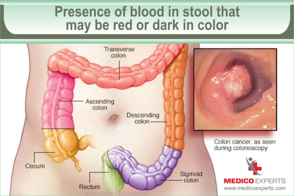 Colon-Cancer-Sign-Symptom-BLOG-Artwork-1-1024x683.png?type=w1