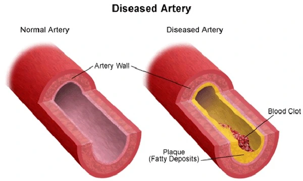 vasculardisease-diagram-veinsdiseasedartery.png?type=w1