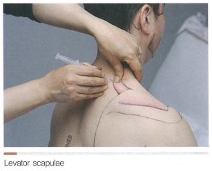 neck-levatorscapulae.PNG