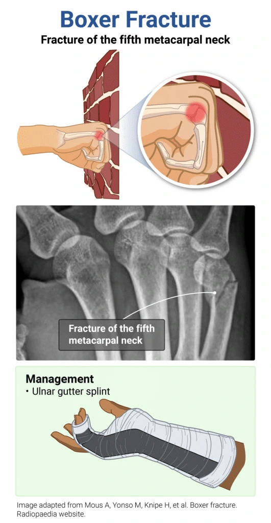 Image-Boxer-Fracture-Fifth-Metacarpal-8x-531x1024.png?type=w1