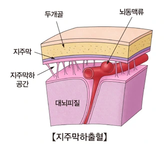 지주막하출혈.PNG