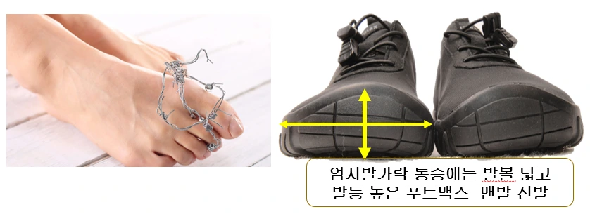 엄지 발가락 통증 지간신경종 무지외반증 엄지발가락 푸트맥스 발볼넓은 맨발신발.PNG