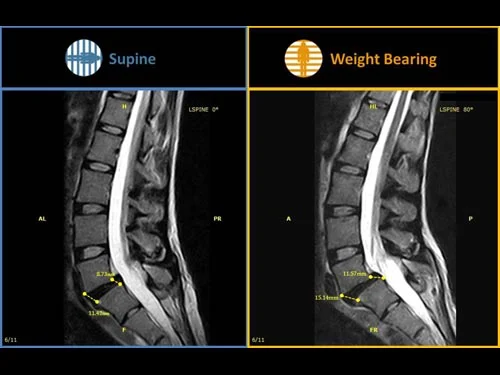 gScanBrio_Anterolisthesis_10.jpg?type=w2