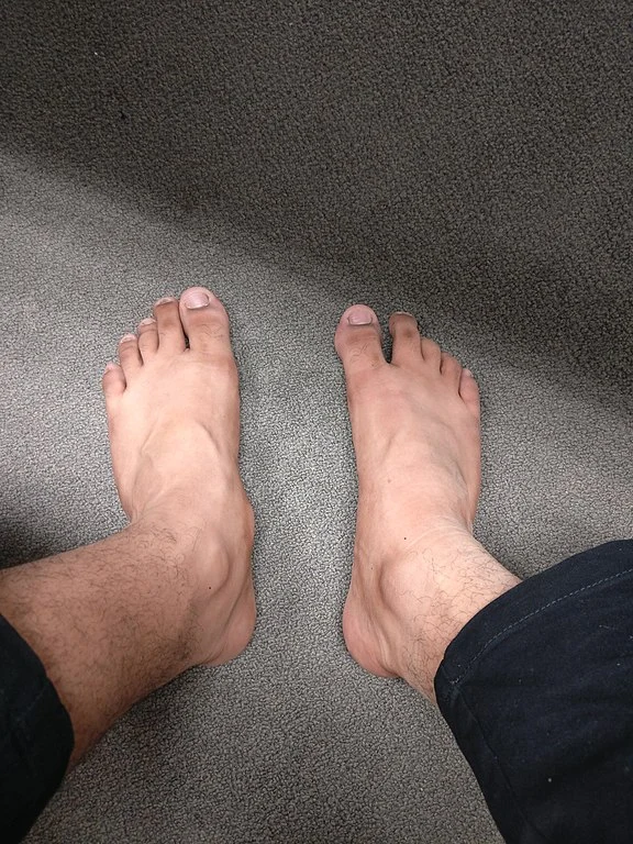 576px-Acessory_Navicular_Bone_2.jpg?type=w1