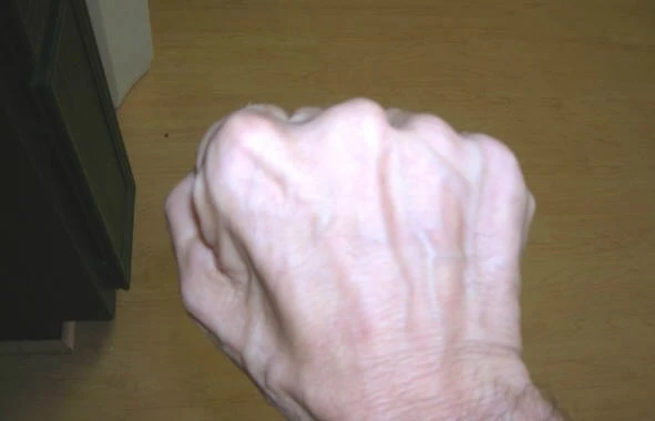 muscle_atrophy_in_right_hand_caused_by_damage_to_the_ulnar_nerve-closed-fistb.JPG?type=w2