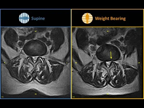 gScanBrio_FacetJointInstability_10.jpg?type=w2
