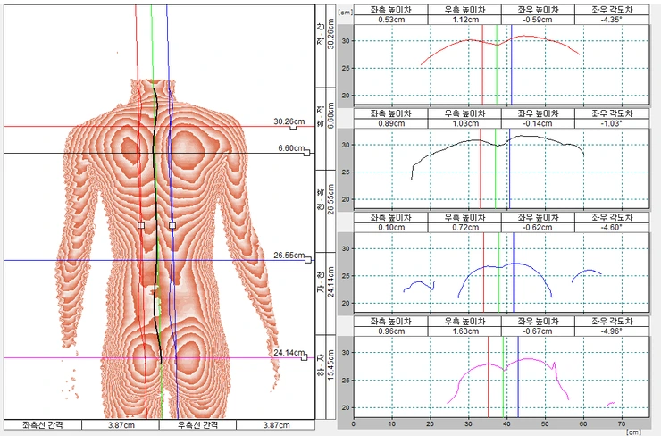 %EC%B8%A1%EB%A7%8C%EC%A6%9D%2C_%EB%B6%88%EA%B7%A0%ED%98%95_29%EC%84%B8_%EB%82%A8_%28170222%29.png?type=w2