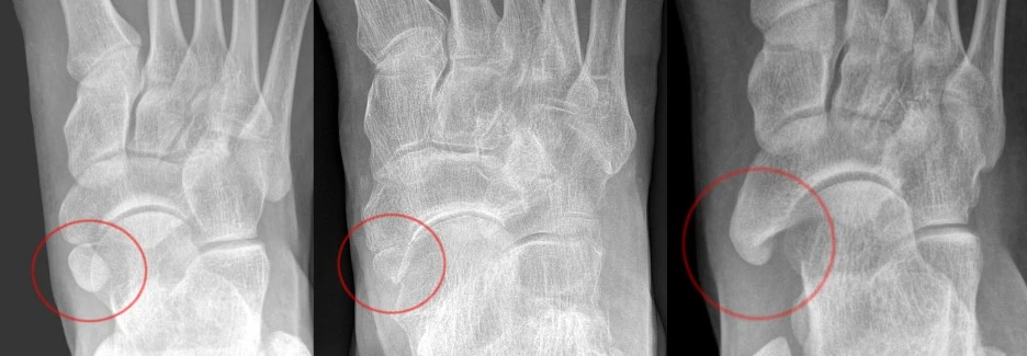 Os_tibiale_externum_Typen_1_-_3_nach_Geist_-_Roe.jpg?type=w1