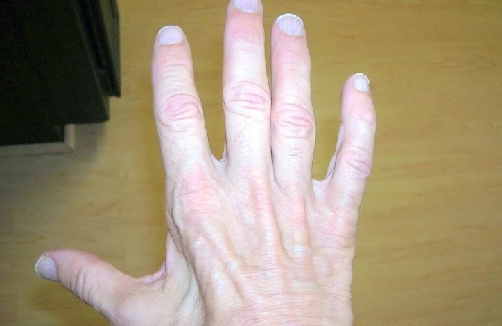 ulnar-nerve-damaged-hand-large.jpg?type=w2