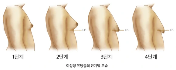%EC%97%AC%EC%84%B1%ED%98%95_%EC%9C%A0%EB%B0%A9%EC%A6%9D_%EB%8B%A8%EA%B3%84%EB%B3%84_%EB%AA%A8%EC%8A%B5.png?type=w580