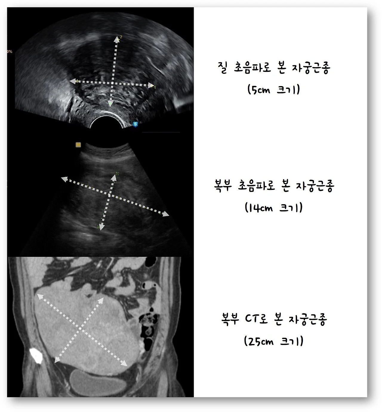 %EC%9E%90%EA%B6%81%EA%B7%BC%EC%A2%85%20%EC%B4%88%EC%9D%8C%ED%8C%8C.jpg?zoom=1.25&w=640&ssl=1