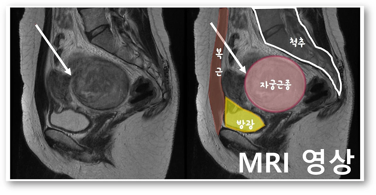MRI%20%EC%98%81%EC%83%81.jpg?zoom=1.25&w=640&ssl=1