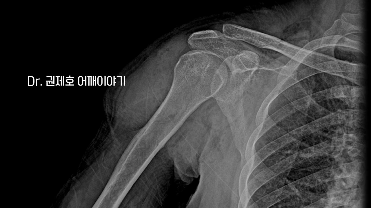 회전근개봉합수술 (18).JPG