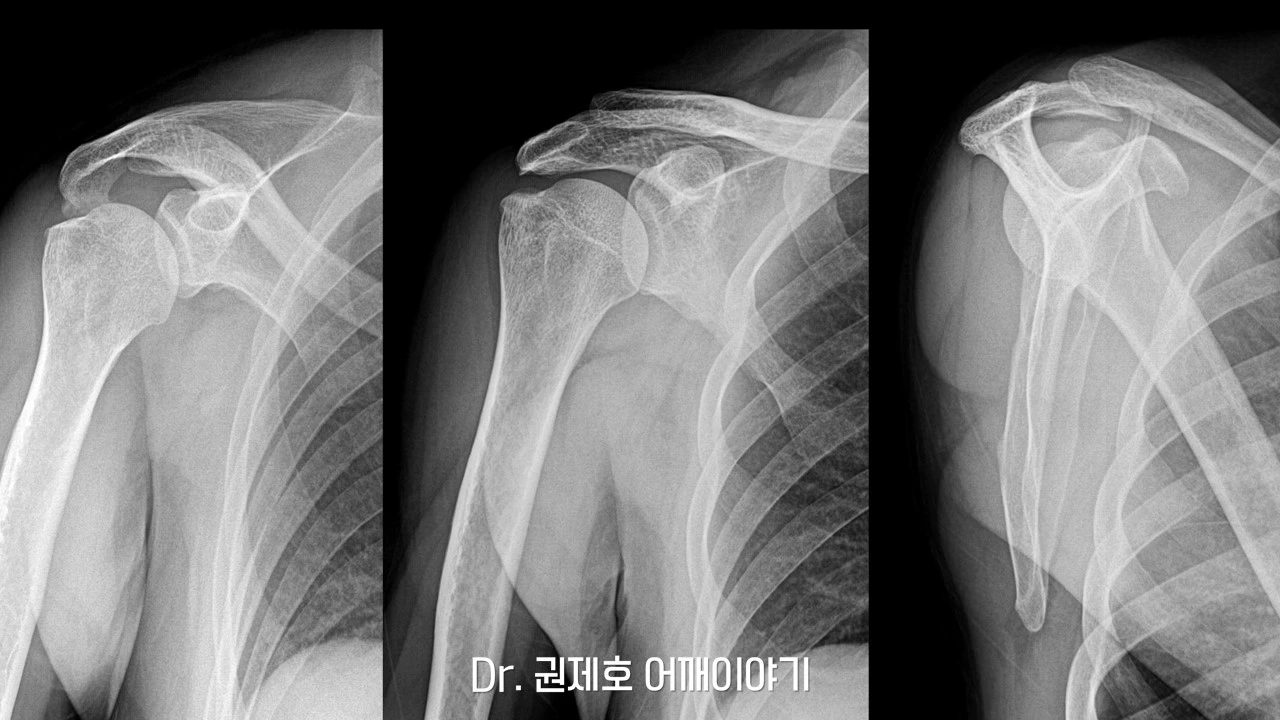 회전근개봉합수술 (4).JPG