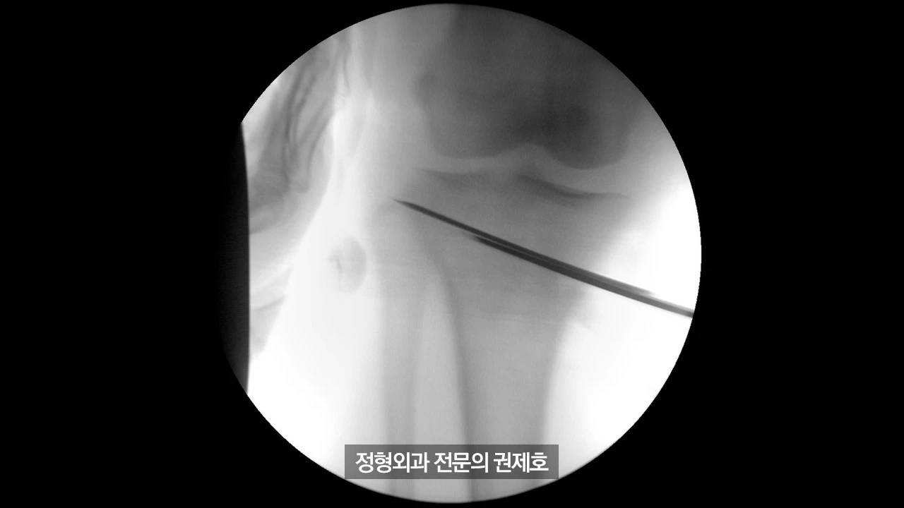 무릎절골술 (18).JPG