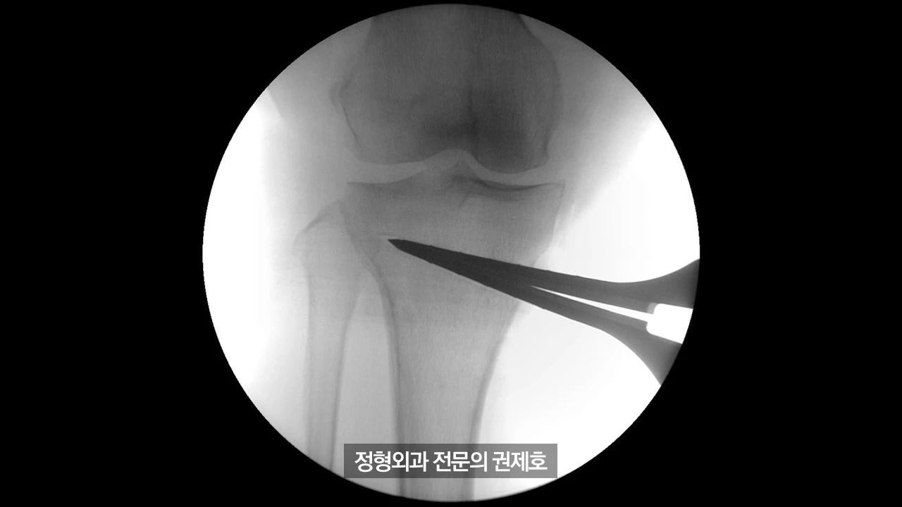무릎절골술 (24).JPG