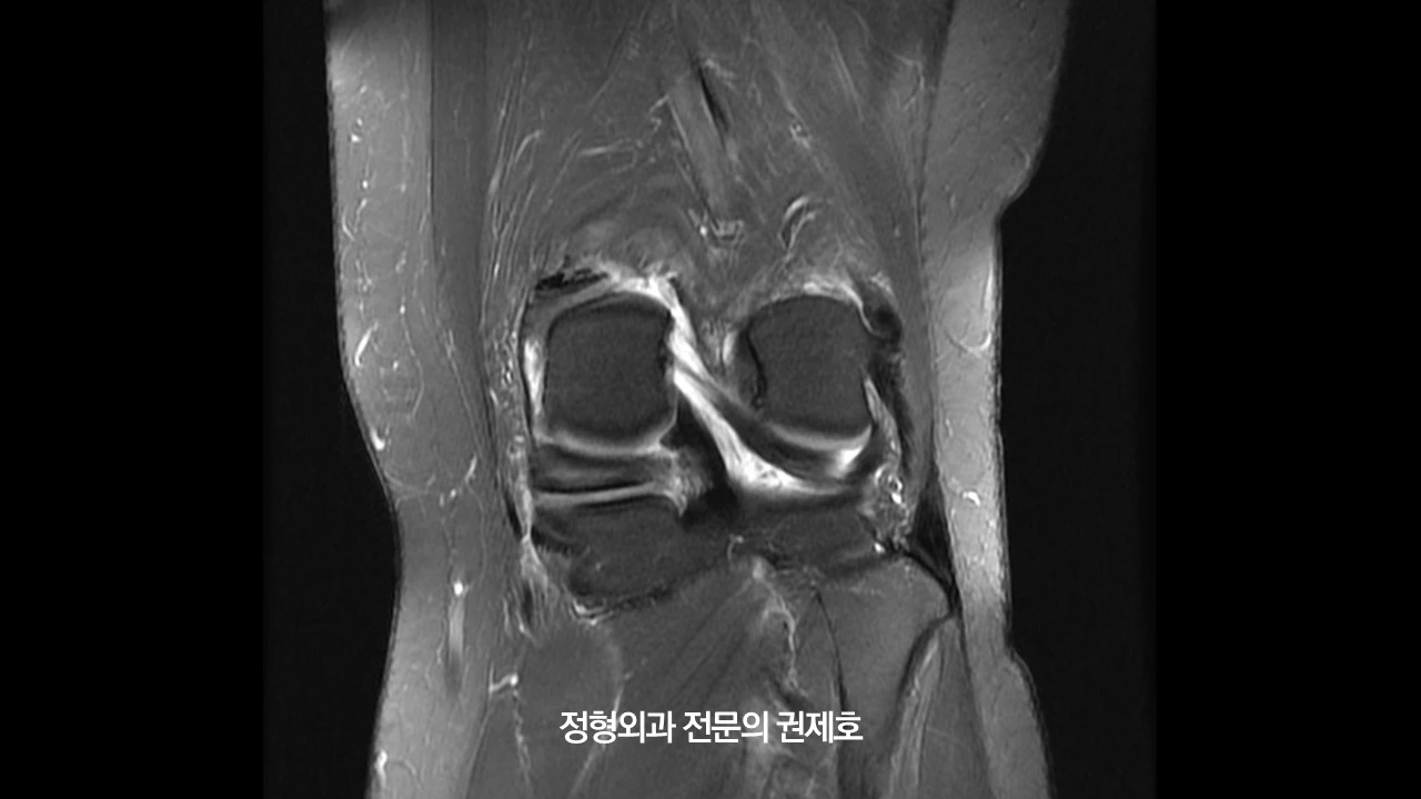 무릎절골술 (11).JPG