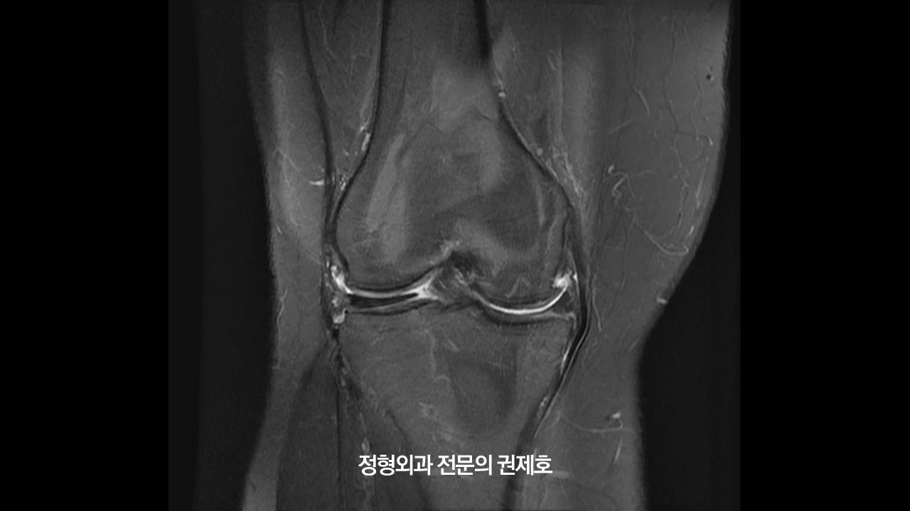 무릎절골술 (6).JPG