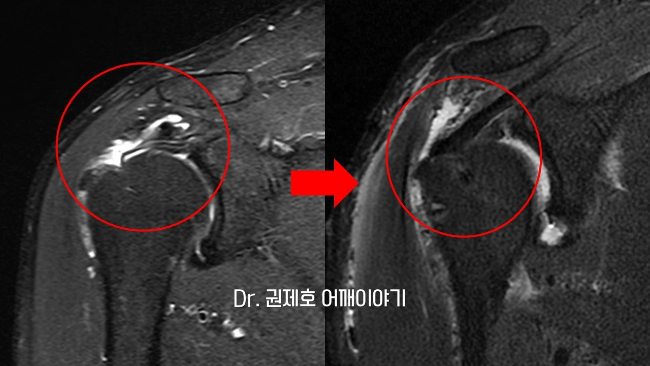 회전근개봉합수술 (25).JPG