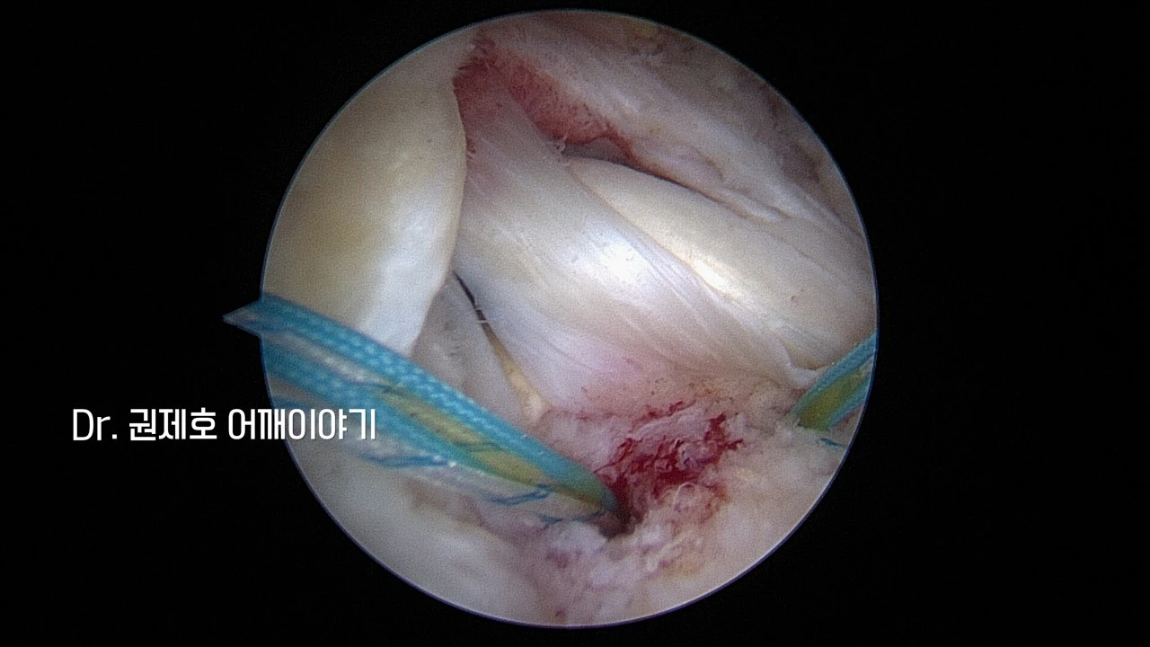 회전근개봉합수술 (16).JPG