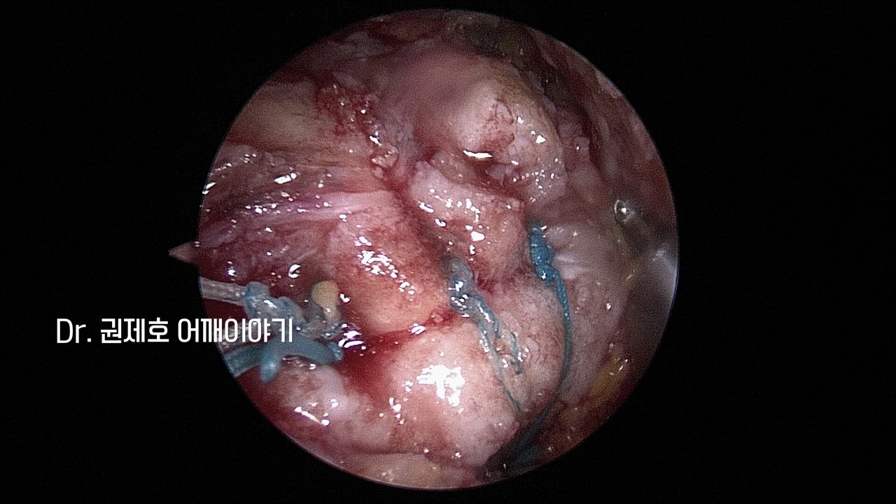 회전근개봉합수술 (17).JPG