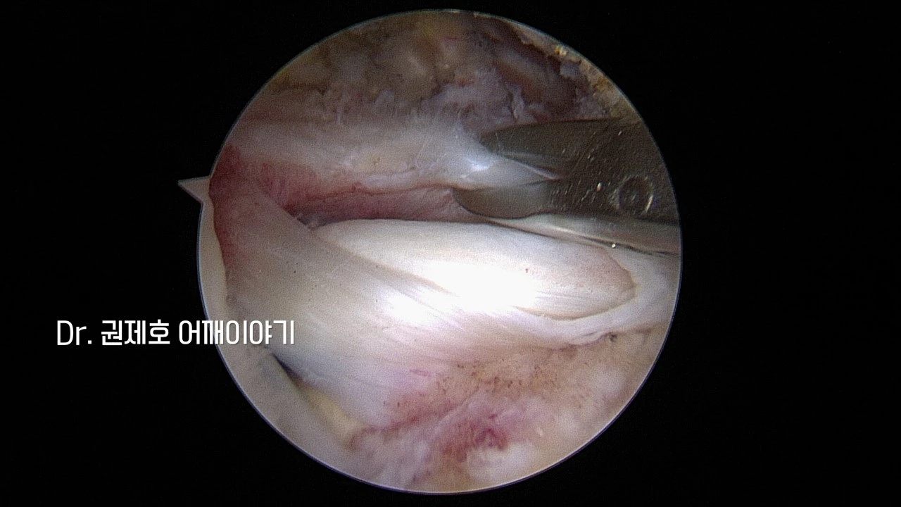 회전근개봉합수술 (15).JPG