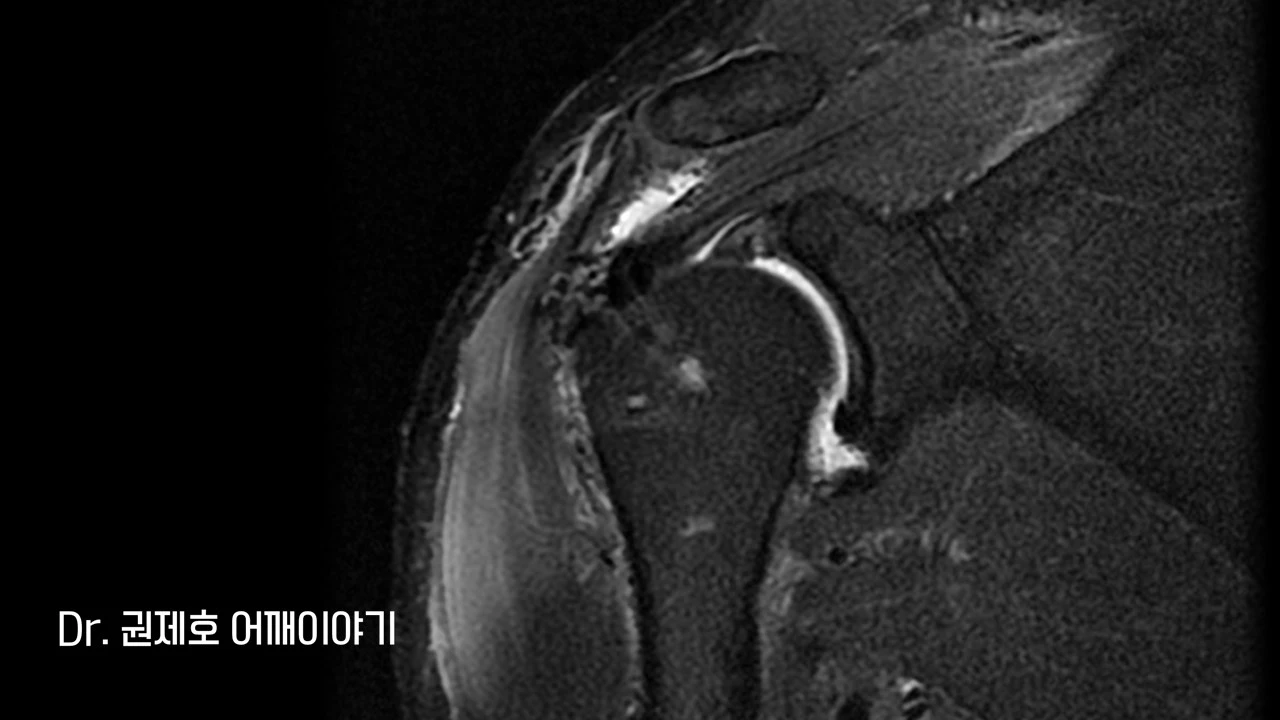 회전근개봉합수술 (22).JPG
