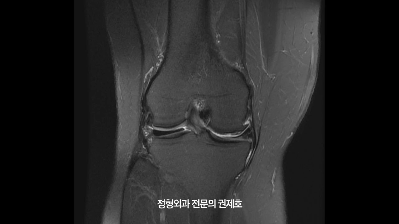 무릎절골술 (7).JPG