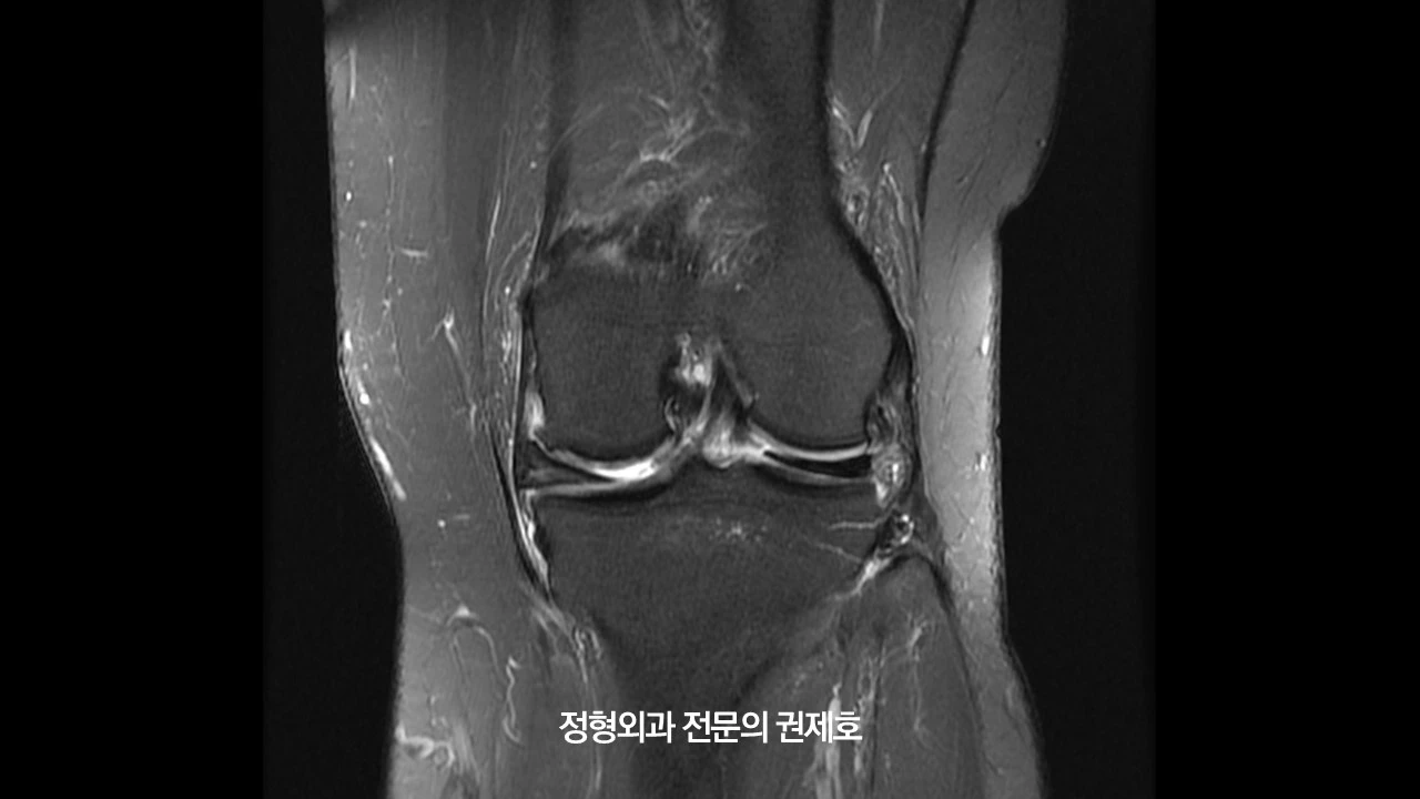 무릎절골술 (10).JPG