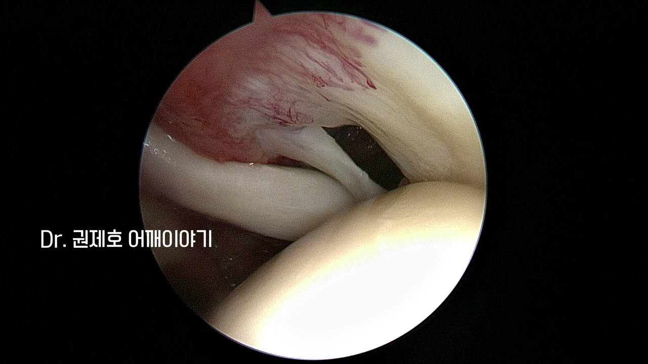 회전근개봉합수술 (11).JPG