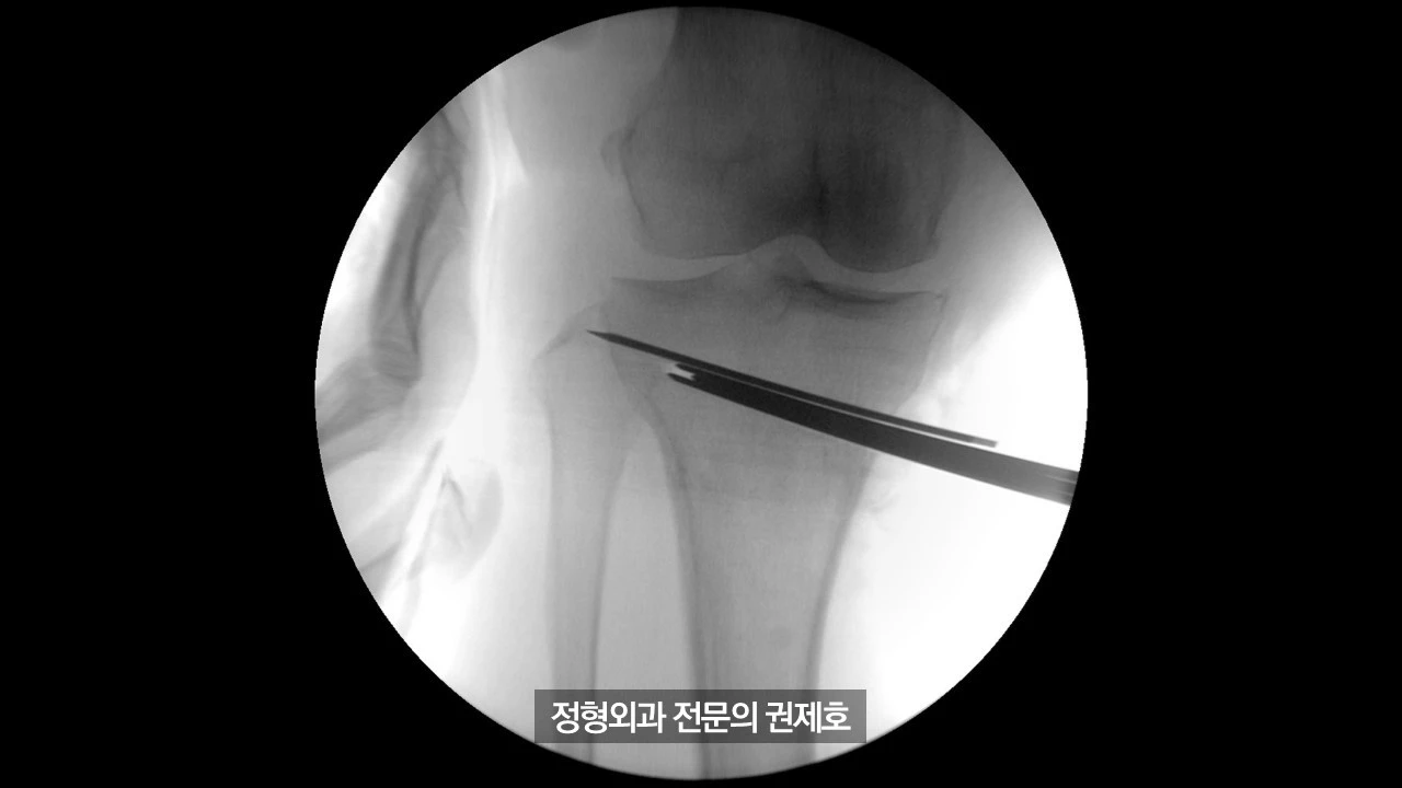 무릎절골술 (21).JPG