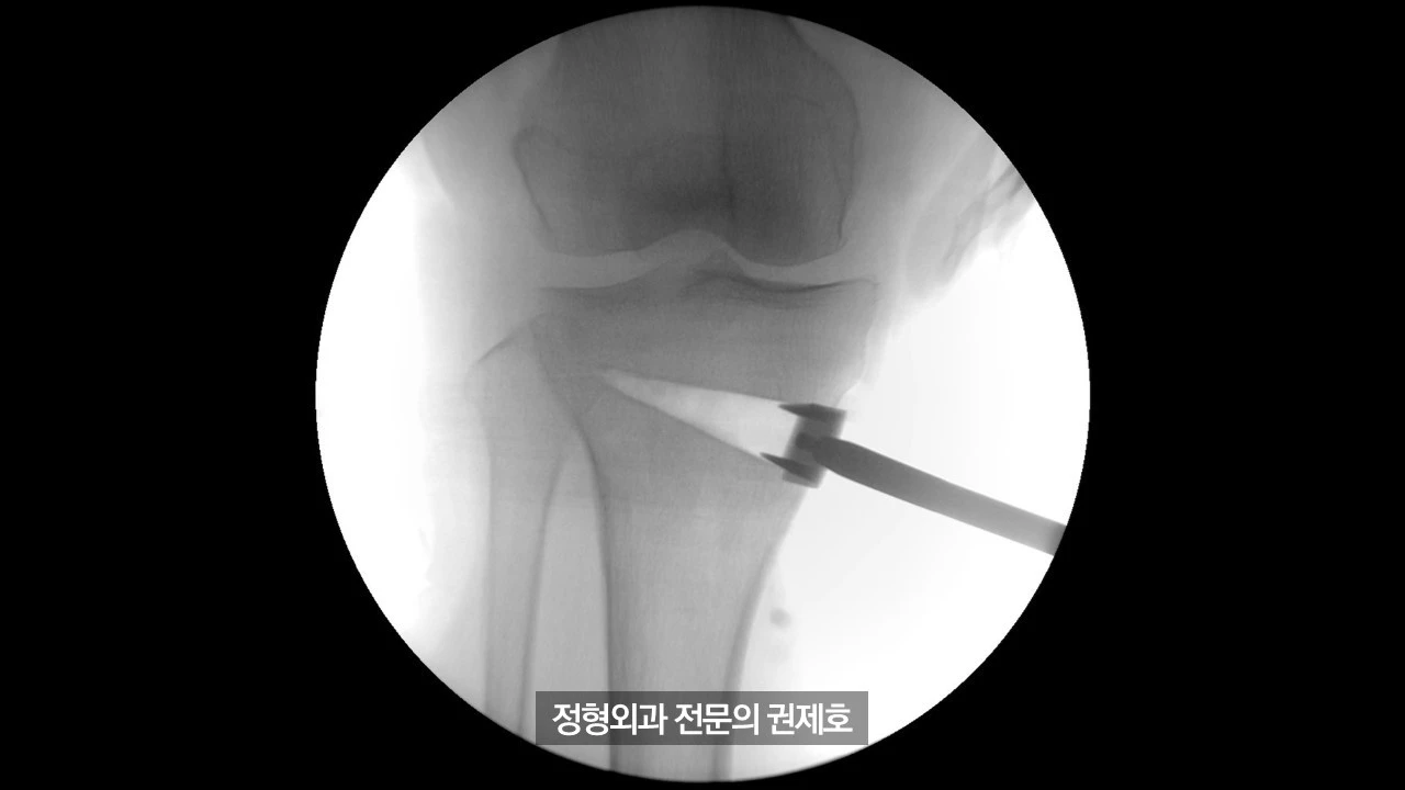 무릎절골술 (25).JPG