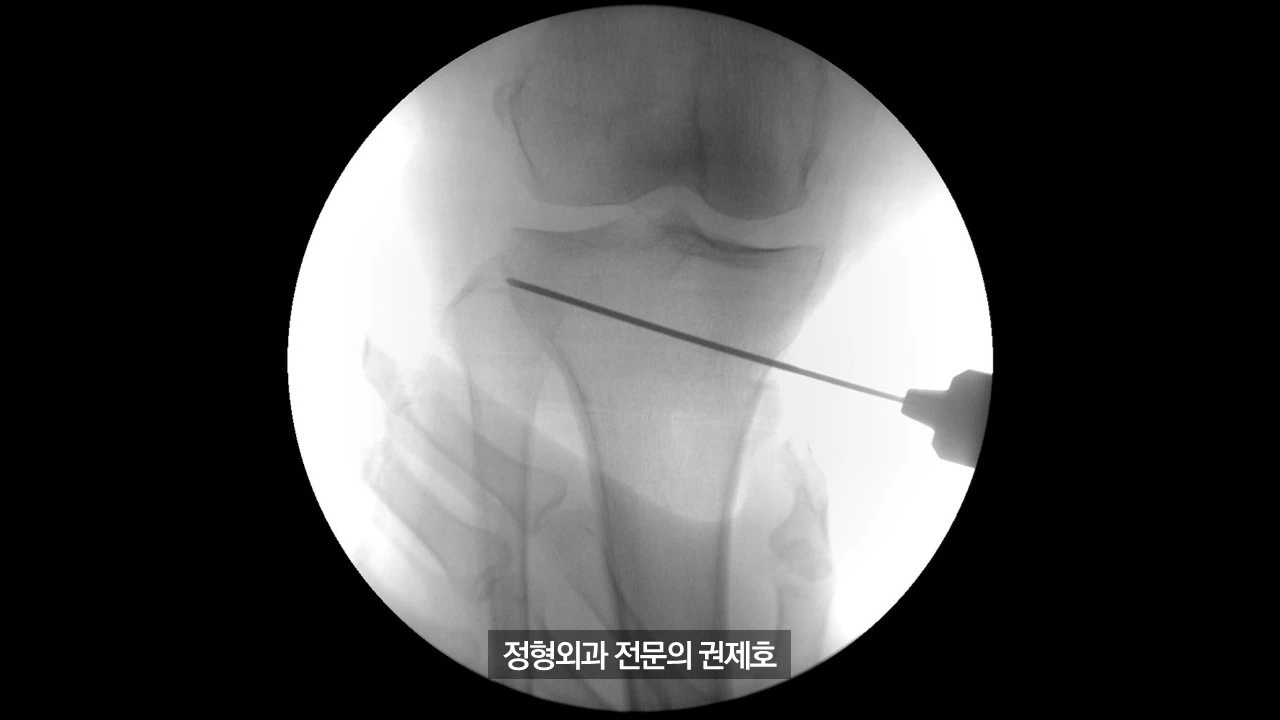 무릎절골술 (16).JPG