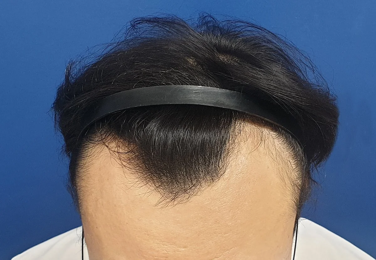 %EC%82%AC%EC%A7%84_%EC%96%91%EC%AA%BD_%EB%81%9D%EC%9D%98_%EC%95%9E%EB%A8%B8%EB%A6%AC_%ED%97%A4%EC%96%B4%EB%9D%BC%EC%9D%B8%EC%9D%B4_%ED%9B%84%ED%87%B4%ED%95%98%EA%B3%A0_%EC%9E%88%EB%8B%A4%EB%A9%B4_%EC%9C%A0%EC%A0%84%EC%84%B1_%ED%83%88%EB%AA%A8%EB%A5%BC_.jpg?type=w1200