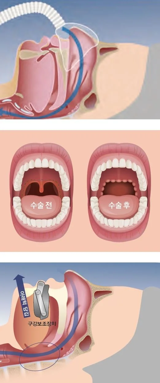 %EC%88%98%EC%88%A0%EC%B9%98%EB%A3%8C.JPG?type=w1200