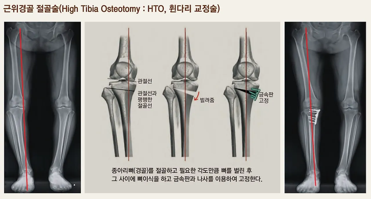 근위경골절골술.JPG