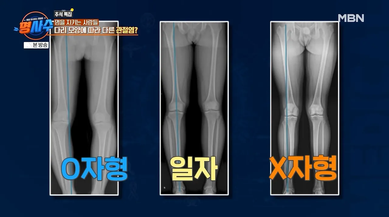 명사수_정형외과 이성산 교수3.JPG